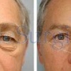 Eye Bag Removal & Upper Eye... - Elite Surgical Ltd