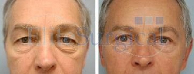 Eye Bag Removal & Upper Eyelid Surgery at Elite Su Elite Surgical Ltd