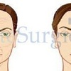 Facelift Treatments - One S... - Elite Surgical Ltd