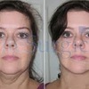 Neck Lift Surgery at Elite ... - Elite Surgical Ltd