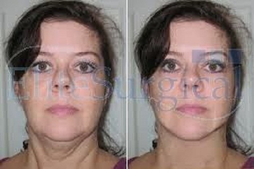 Neck Lift Surgery at Elite Surgical Elite Surgical Ltd