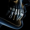 Dental Implants - Greenwood Plenty Dental Care