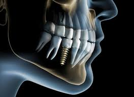 Dental Implants Greenwood Plenty Dental Care
