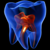 Root Canal Endodontics - Greenwood Plenty Dental Care