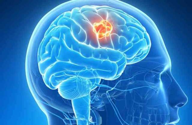 illustration-of-a-brain-tumor-shutterstock-800x430 http://supplementaustralia.com.au/cerebral-boost/
