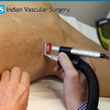 Varicose Veins Best Treatme... - Indian vascular surgery