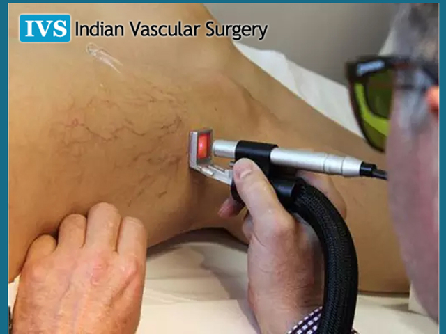 Varicose Veins Best Treatment in India - Indian va Indian vascular surgery