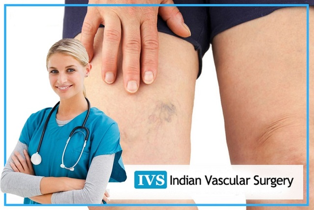 Laser Varicose Veins Treatment in Mohali - Indian  Indian vascular surgery