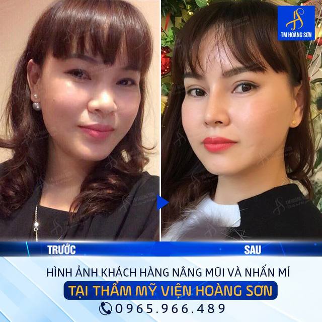 Kh Ã¡ hoa Tháº©m Má»¹ Viá»‡n BÃ¡c SÄ© HoÃ ng SÆ¡n