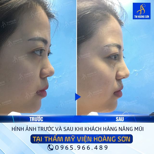 Kh minh tuyáº¿t loan Tháº©m Má»¹ Viá»‡n BÃ¡c SÄ© HoÃ ng SÆ¡n