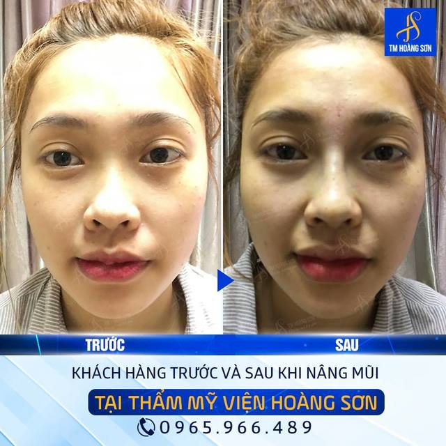 kh minh vy oanh Tháº©m Má»¹ Viá»‡n BÃ¡c SÄ© HoÃ ng SÆ¡n