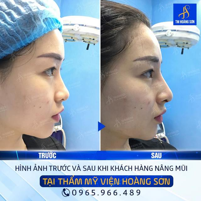 Kh phá»¥ng minh vy Tháº©m Má»¹ Viá»‡n BÃ¡c SÄ© HoÃ ng SÆ¡n