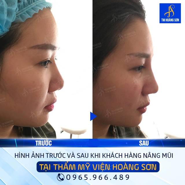 Kh tráº§n kim ly Tháº©m Má»¹ Viá»‡n BÃ¡c SÄ© HoÃ ng SÆ¡n