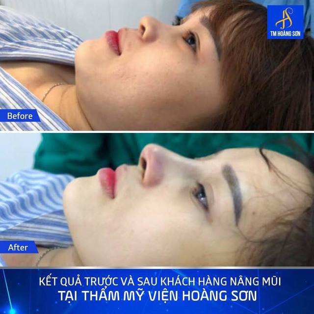 Kh trá»‹nh trá»‹nh ká»³ Tháº©m Má»¹ Viá»‡n BÃ¡c SÄ© HoÃ ng SÆ¡n