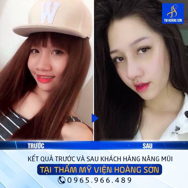 Kh tuyáº¿t minh Tháº©m Má»¹ Viá»‡n BÃ¡c SÄ© HoÃ ng SÆ¡n