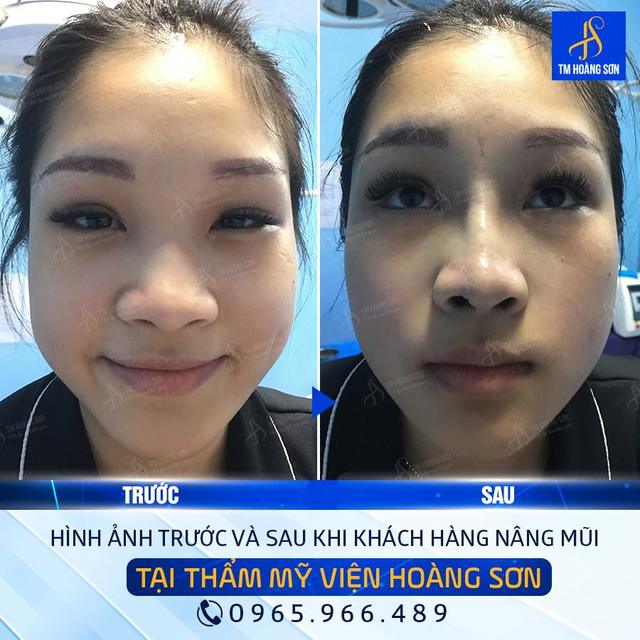 Kh tuyáº¿t trá»‹nh Tháº©m Má»¹ Viá»‡n BÃ¡c SÄ© HoÃ ng SÆ¡n