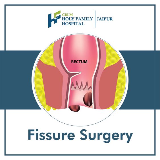Fissure Surgery Picture Box