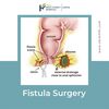 Fistula  Surgery - Picture Box