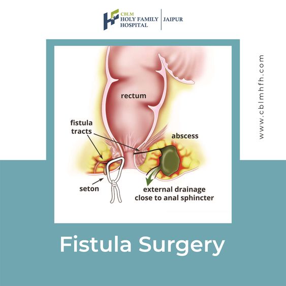 Fistula  Surgery Picture Box