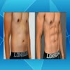 liposuction melbourne - cosmosclinic