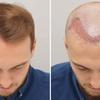 Hair Transplant - Picture Box