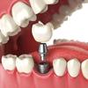 Dental Implants - Picture Box