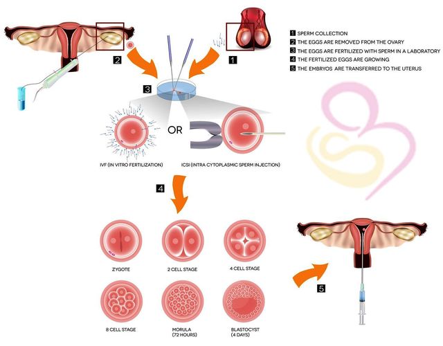 ICSI treatment in Hyderabad IVF Clinic