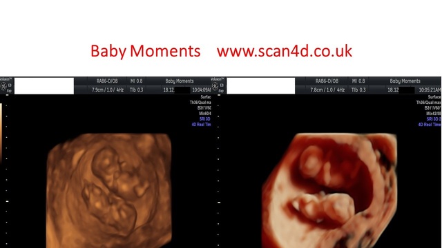 scan in pregnancy a baby scan