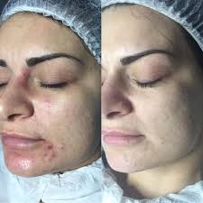 Dermal Fillers Manchester La Rocka Aesthetic Clinic Ltd