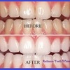 Radiance Teeth Whitening - Picture Box