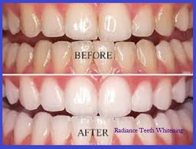 Radiance Teeth Whitening Picture Box