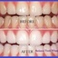 Radiance Teeth Whitening - Picture Box