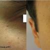 face-skin-tag-removal-07 - Therapeutic massage Melton ...