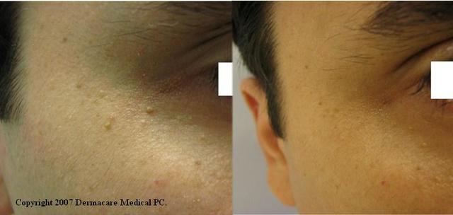 face-skin-tag-removal-07 Therapeutic massage Melton | Revival Beauty Spaa