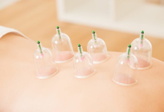 5 Cupping Therapy Melbourne Acupuncture In Melbourne