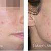 Clear skin laser treatments - Picture Box