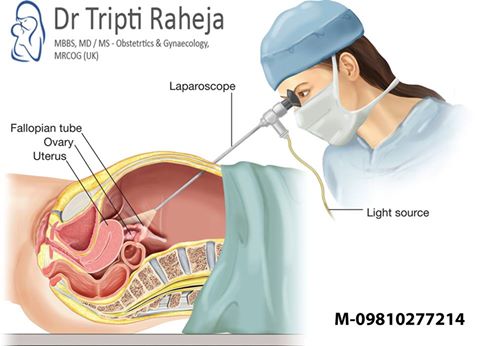 Gyne Laparoscopy Surgeon in North Delhi, Treatment Picture Box