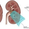 Kidney Transplant Surgeon i... - Picture Box