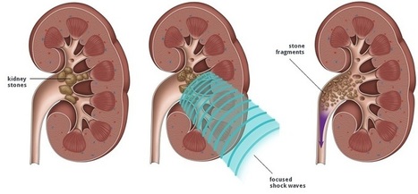 Kidney Transplant Surgeon in Ghaziabad, Kidney Fai Picture Box