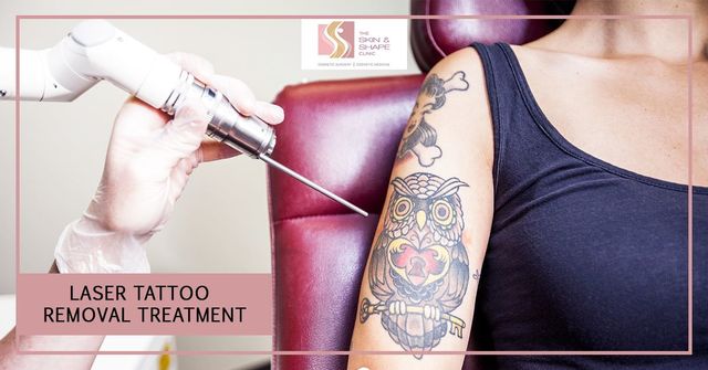 Top Laser Tattoo Removal in Mumbai - Skinandshape Picture Box