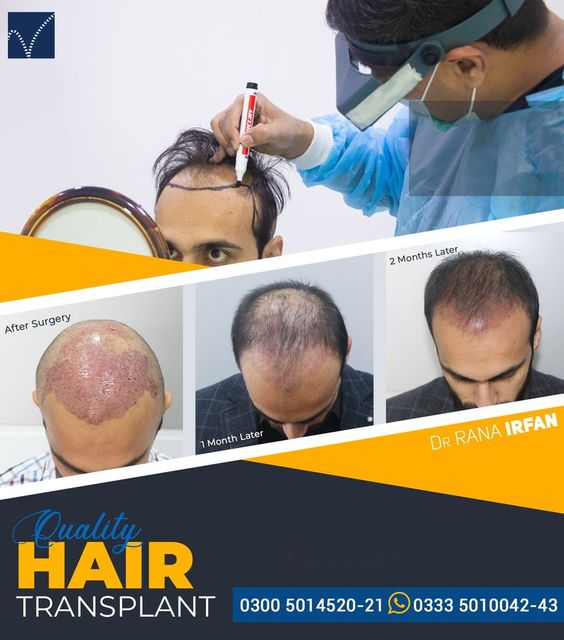 122035110 415864433137482 4142882978326801246 o Vagus Hair Transplant | Dr Rana Irfan