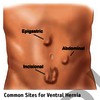 common-hernia - Dr
