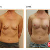 Breast Asymmetry - Picture Box