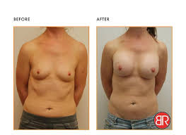 Breast Asymmetry Picture Box