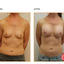 Breast Asymmetry - Picture Box
