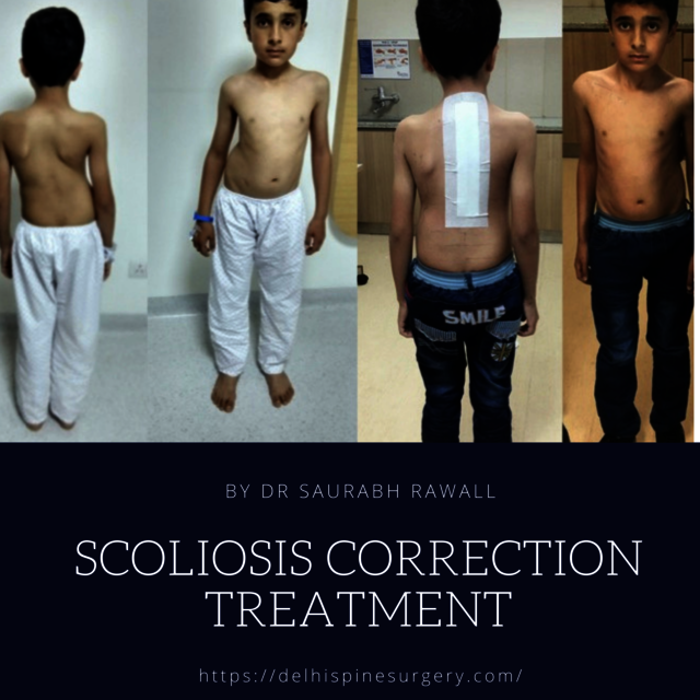 Scoliosis Correction Treatment By Best Spine Surge Picture Box