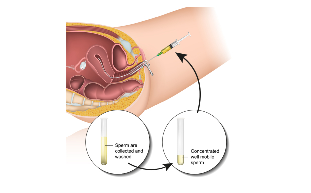 Clinic offering  PGS PGT-A PGT-SR PGD Fertility Clinic in Limassol, CY