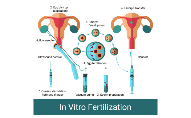 Pregnancy using egg donation Fertility Clinic in Limassol, CY