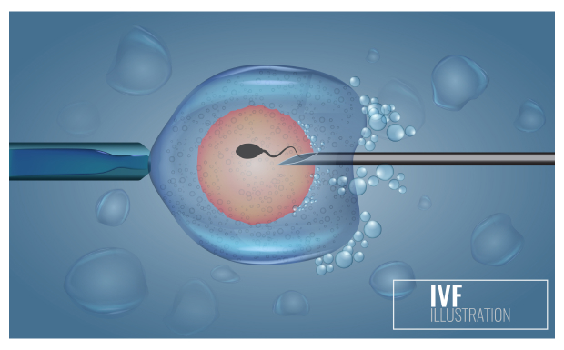 Sperm donation Fertility Clinic in Limassol, CY