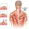 Trigger-Point-Injections-Do... - Neck Pain Downtown